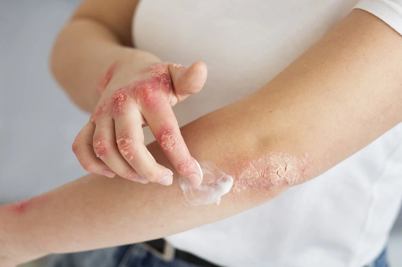 Psoriasis Bukan Hanya Masalah Kulit: Kenali Pemicu dan Gejalanya