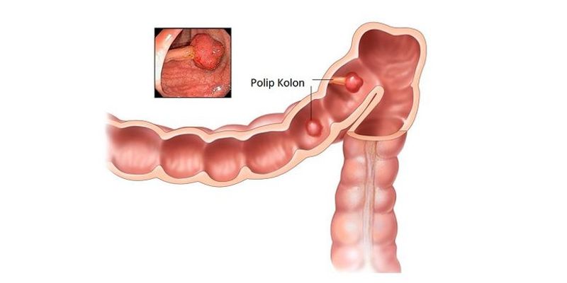 kanker usus