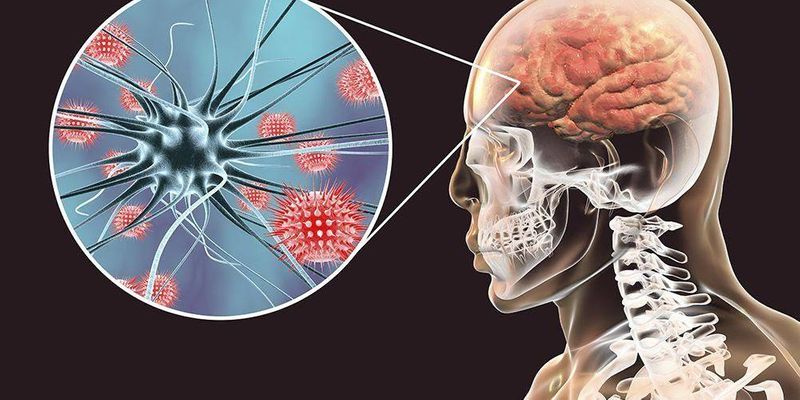 meningitis