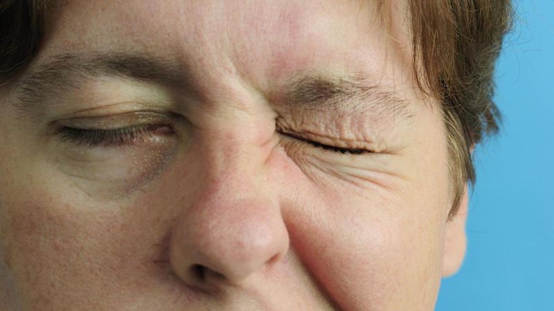 bell's palsy