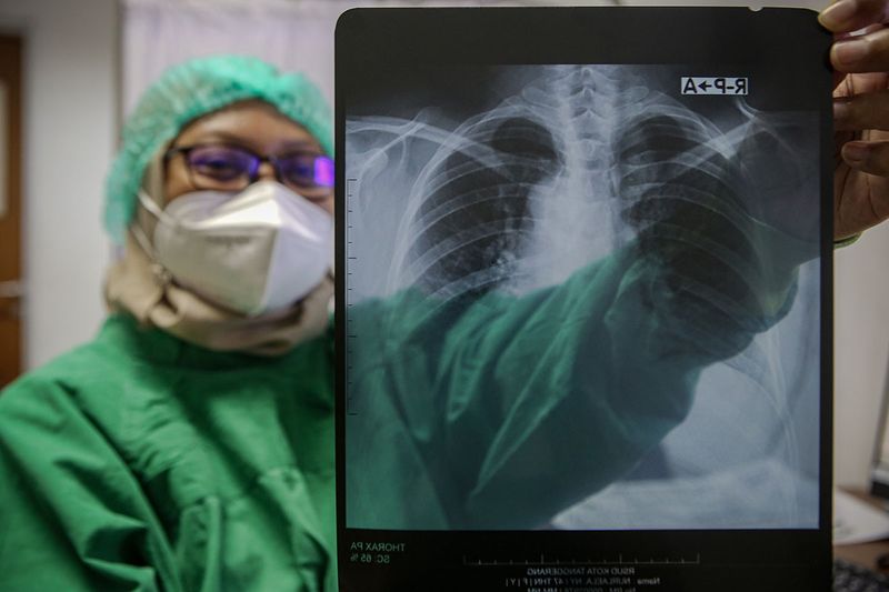 deteksi-tuberkulosis-di-tangerang-6