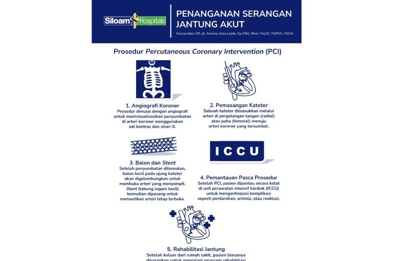 Mengenal gejala dan prosedur PCI untuk serangan jantung akut.