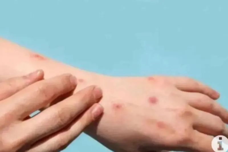 Ilustrasi cacar monyet atau monkey pox