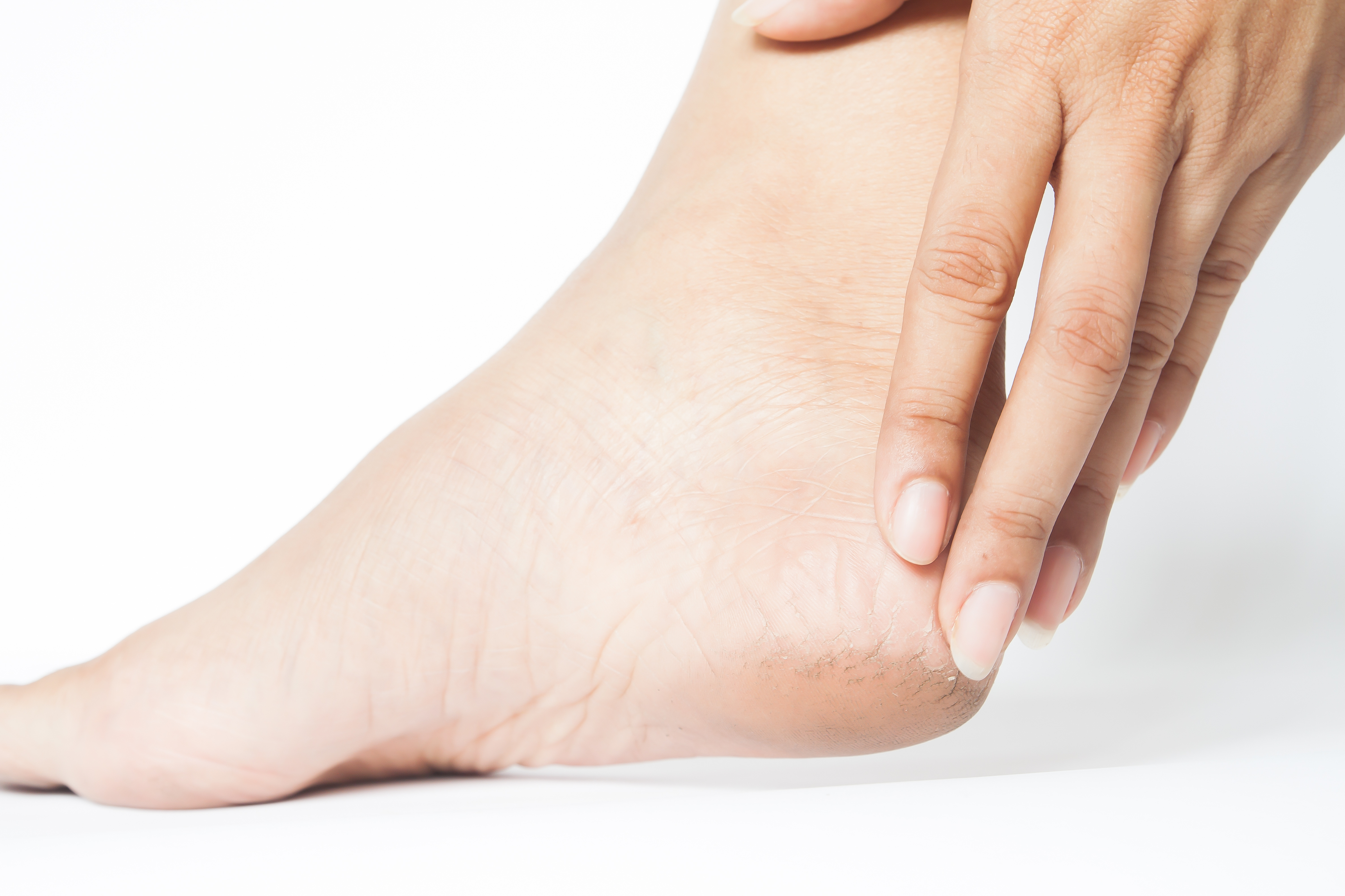 5 Tips Sederhana Mengilangkan Serpihan Kulit Kaki Pecah-Pecah