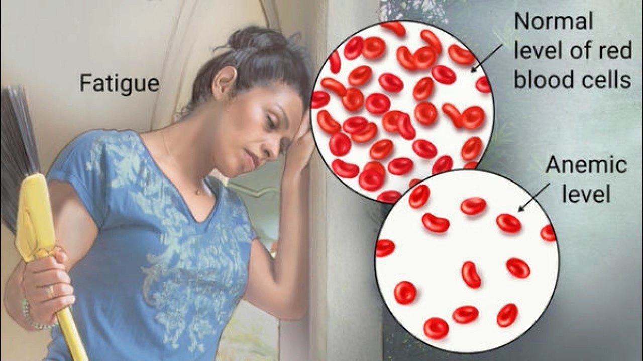 6 Gejala Kurang Darah Akibat Anemia yang Wajib Anda Ketahui!