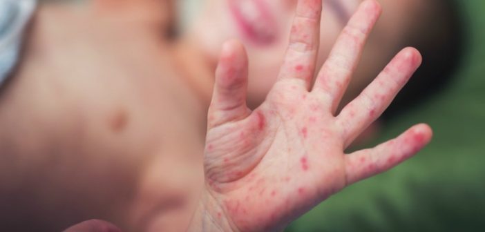 Jangan Anggap Remeh, Kenali Campak Dan Rubella !