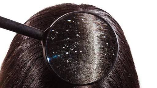 Punya-Masalah-Rambut-Ketombe-doc.rambut-ivoox.id_