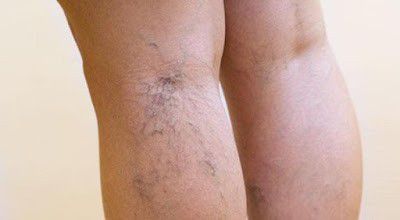 Pencegahan-dan-Cara-Mengatasi-kaki-Varises-doc.varises-ivoox.id_